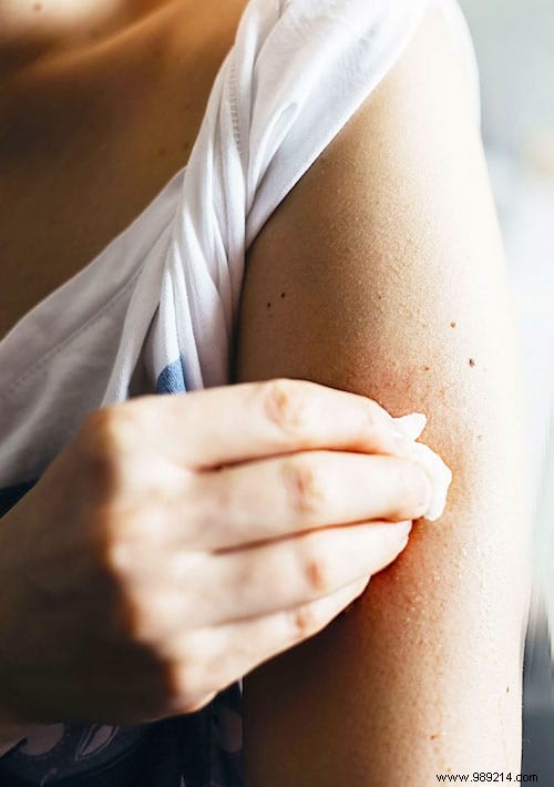 5 Magical Remedies To Calm A Mosquito Bite Instantly. 