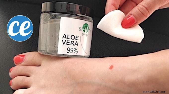 Blister Light Bulb Which Hurts? Use Aloe Vera To Cure It Quickly. 