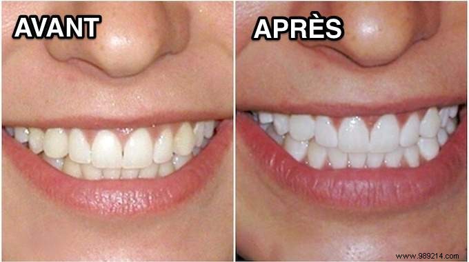 The 3 Best Remedies For Having White Teeth At A Glance. 