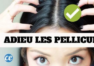 12 Ultra-Effective Remedies To Eliminate Dandruff Naturally. 