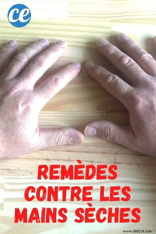 6 Grandma s Remedies To Say Goodbye To Dry, Damaged Hands. 
