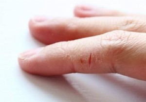 Heal Painful Cracked Fingers Naturally with This Proven Clay and Olive Oil Remedy
