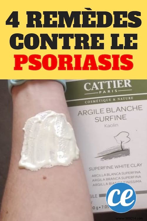 4 White Clay Remedies To Cure Psoriasis Forever. 