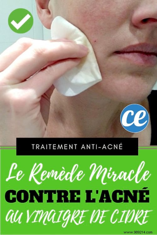 The Miracle Acne Cure NOBODY KNOWS. 
