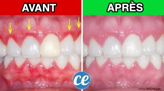 Gingivitis:The Natural And Effective Remedy To Quickly Calm Pain. 