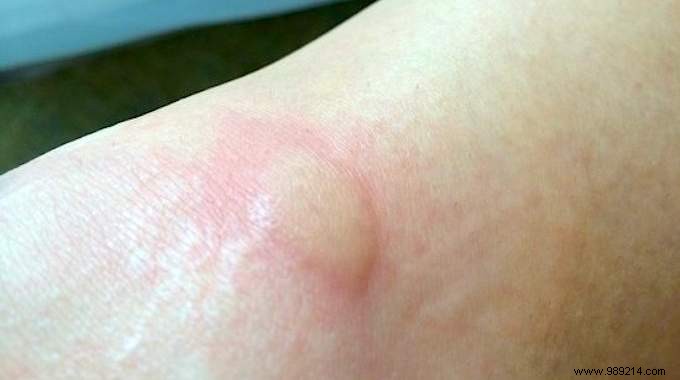 The Natural Tip To Relieve A Mosquito Bite Instantly. 