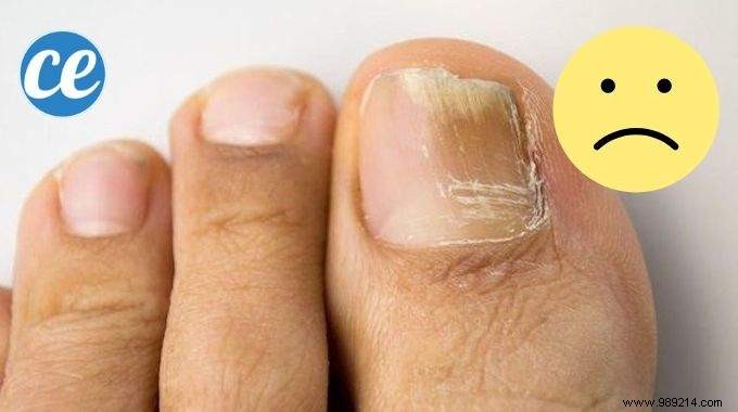How to Get Rid of Foot Fungus in Just 3 Steps. 
