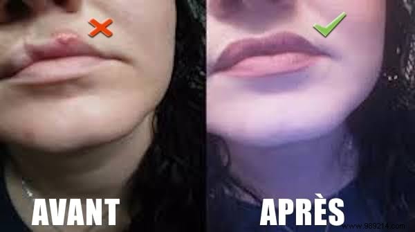 Herpes on the Lip:The Magic Remedy to Stop It Net! 