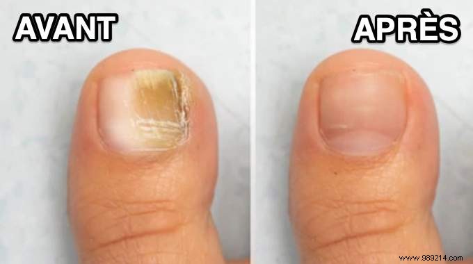 Nail Mycosis:The Miracle Remedy To Get Rid Of It Easily. 