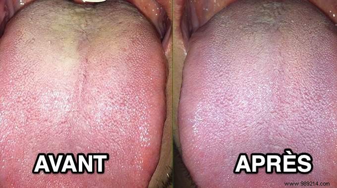 Oral Thrush:The Tried And Approved Remedy To Get Rid Of It Fast. 
