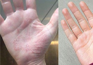Proven Natural Remedy for Hand Eczema: Aloe Vera and Sesame Oil