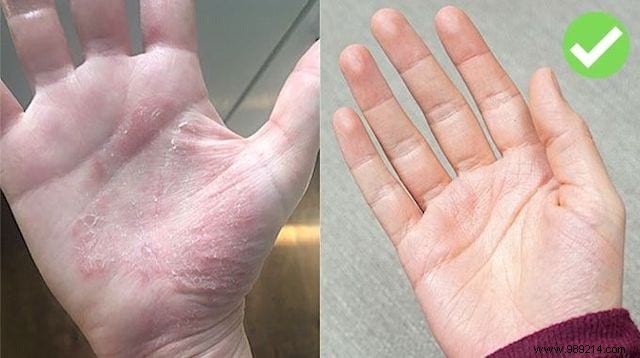 The Miracle Remedy For Eczema On The Hands. 