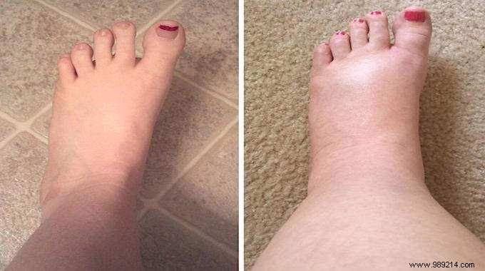 Are Your Feet Swelling With The Heat? Here s Grandma s Remedy That Works! 