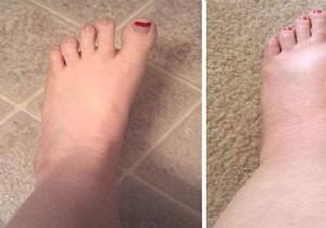 Swollen Feet from Summer Heat? This Proven Magnesium Chloride Foot Soak Provides Fast Relief