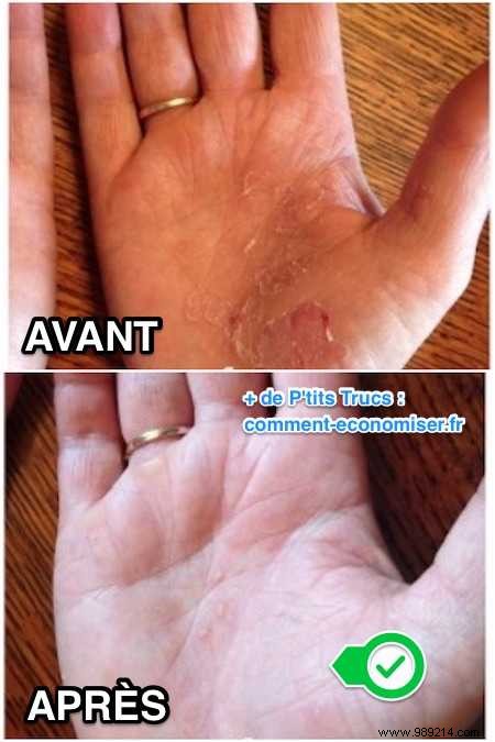 Effective Grandmother s Remedy To Relieve Psoriasis Fast. 
