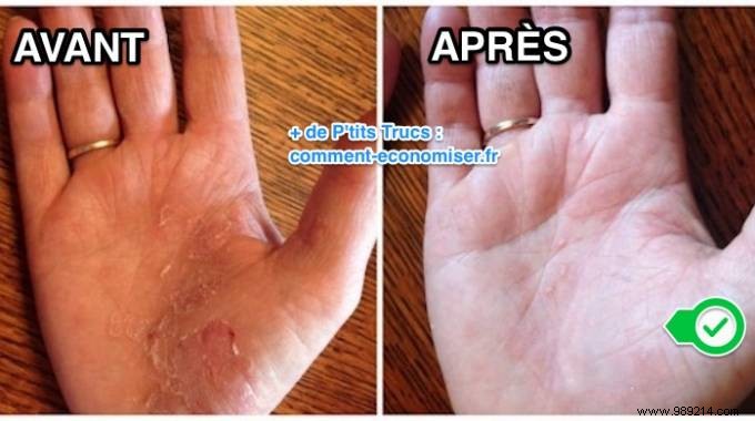 Effective Grandmother s Remedy To Relieve Psoriasis Fast. 