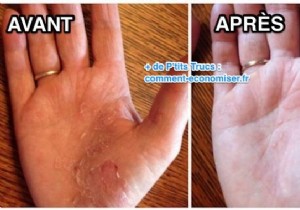 Effective Grandmother s Remedy To Relieve Psoriasis Fast. 