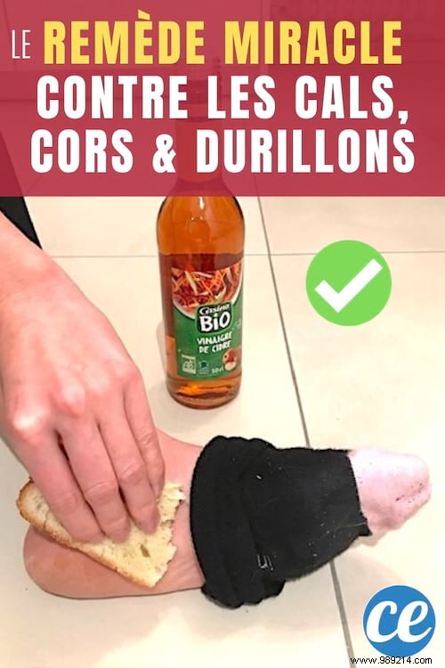 Grandma s Tested And Approved Remedy For Corns And Calluses. 