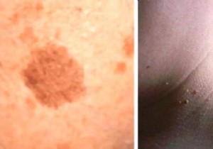 8 Proven Natural Remedies for Warts, Skin Tags, Blackheads, Moles, and Age Spots