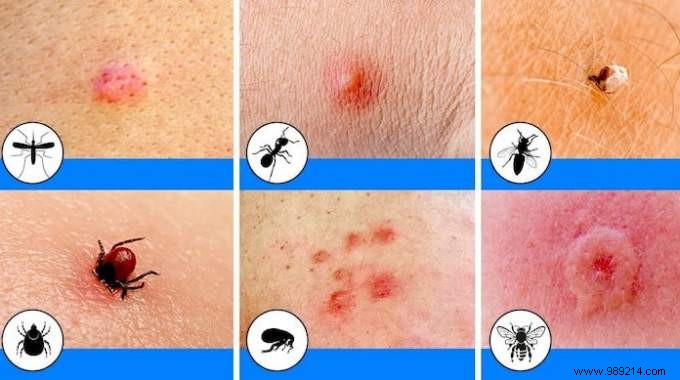 How do I know which insect has bitten me? The Easy Photo Guide. 
