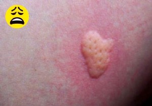 Mosquito Bite:The Miracle Remedy for ITCHING. 