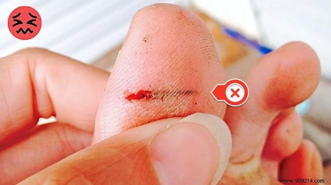 How to remove a deep-set splinter? Grandma s Easy Trick. 