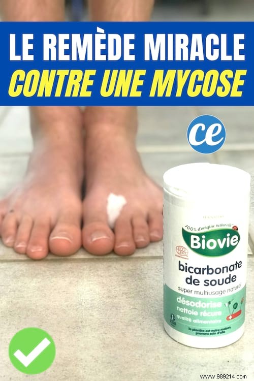 How To Cure Mycosis Naturally With Bicarbonate? 