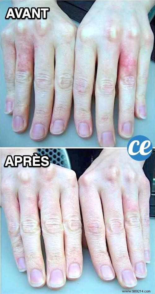 Hands Damaged By Hydroalcoholic Gel? The Miracle and Instant Remedy. 