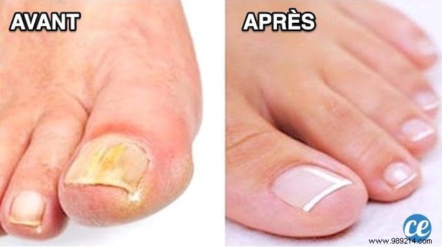 The Radical Remedy for Nail Fungus. 