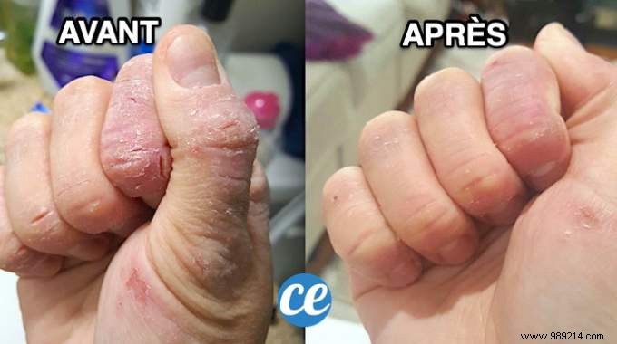Cracks on the Hands:Grandmother s Remedy With Essential Oils. 