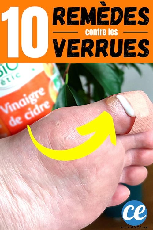 10 Grandma s Tricks To Get A Wart Out QUICKLY. 