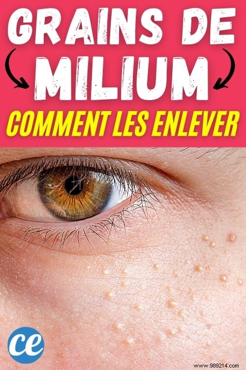 How to Remove Milium Grains Under the Eyes? 16 Natural Treatments. 