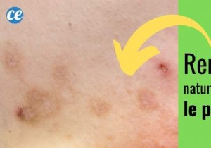 Prurigo:The Magic Remedy To Cure Itching. 