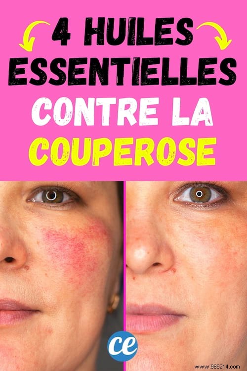 Rosacea:How to Get Rid of It With Essential Oils. 