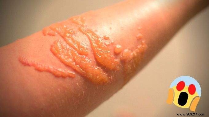 Jellyfish Sting:What Should You Really Do To Relieve It Quickly? 