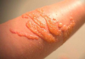 How to Quickly Relieve a Jellyfish Sting: My Surfer-Tested Baking Soda Remedy