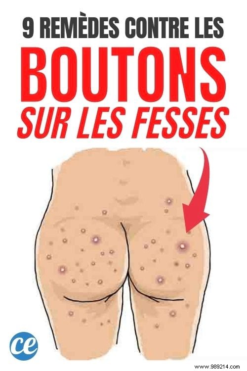 Pimples On The Buttocks:9 Tips To Eliminate Them Forever. 