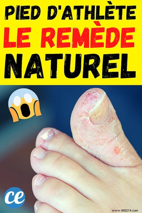 Athlete s Foot:The Quick and Natural Treatment to Get Rid of It. 