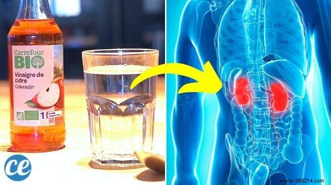 Kidney Failure:The Apple Cider Vinegar Remedy To Relieve You. 
