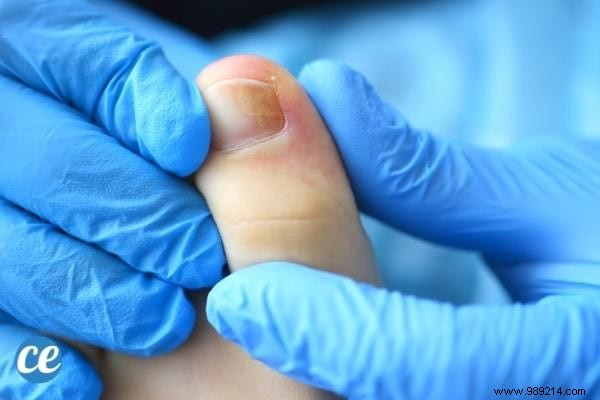 Ingrown Toenail:8 Quick and Effective Remedies to Get Rid of It. 
