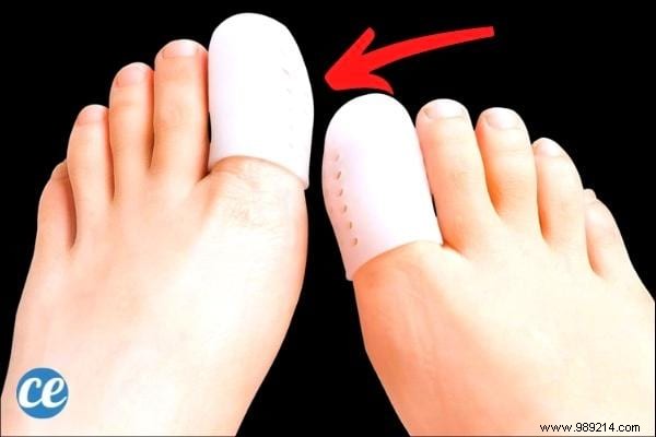 Ingrown Toenail:8 Quick and Effective Remedies to Get Rid of It. 