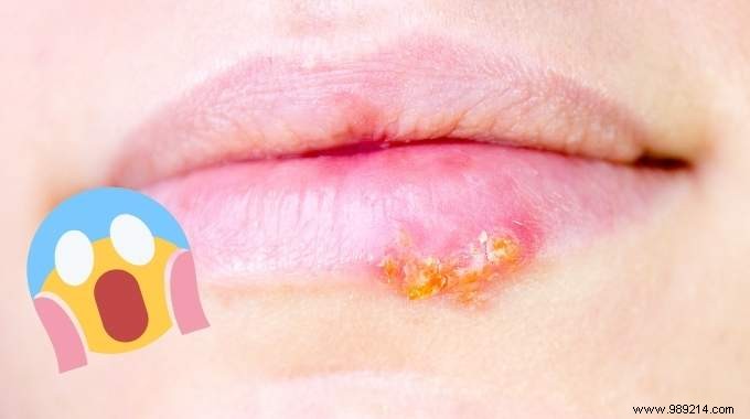 5 Remedies To Accelerate The Healing Of A Cold Sore. 