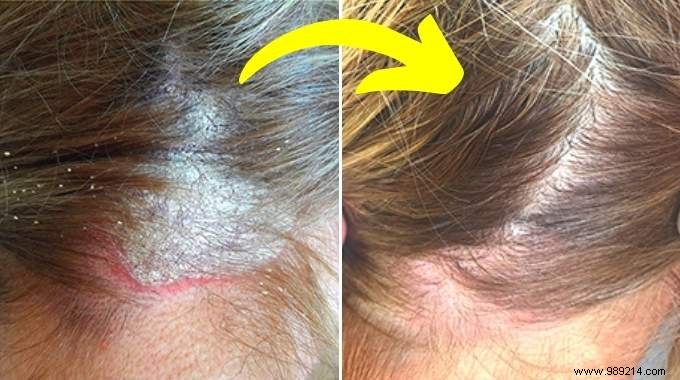 17 Remedies for Scalp Psoriasis (Revealed by a Dermatologist). 