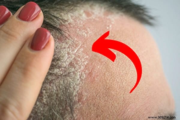 17 Remedies for Scalp Psoriasis (Revealed by a Dermatologist). 