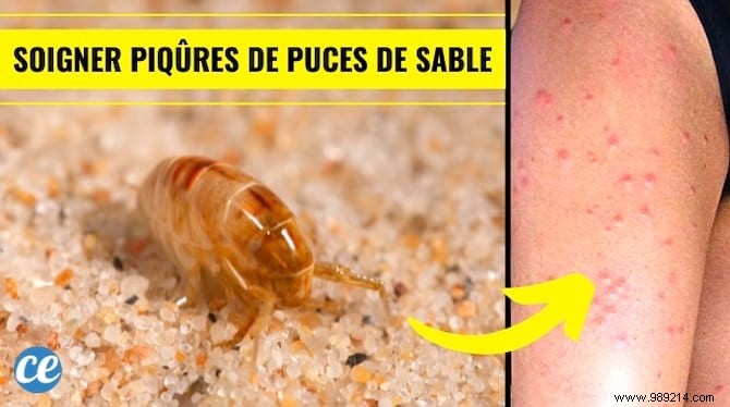 Sand Fleas:How to Relieve Bites INSTANTLY. 