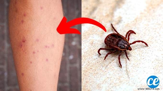 Chiggers:5 Grandmother s Remedies To Stop The Itching. 
