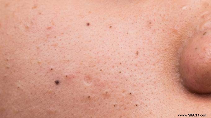 Eliminate blackheads naturally with this remedy. 