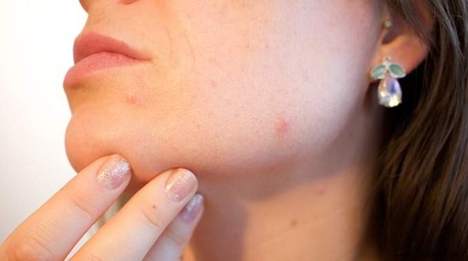 8 Tips to Avoid and Fight Acne. 