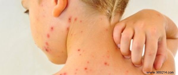 How to Relieve Chicken Pox Itch Naturally? 