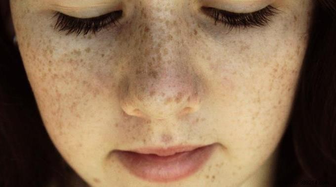 How to Reduce Freckles? My Grandmother s Lemon Recipe. 